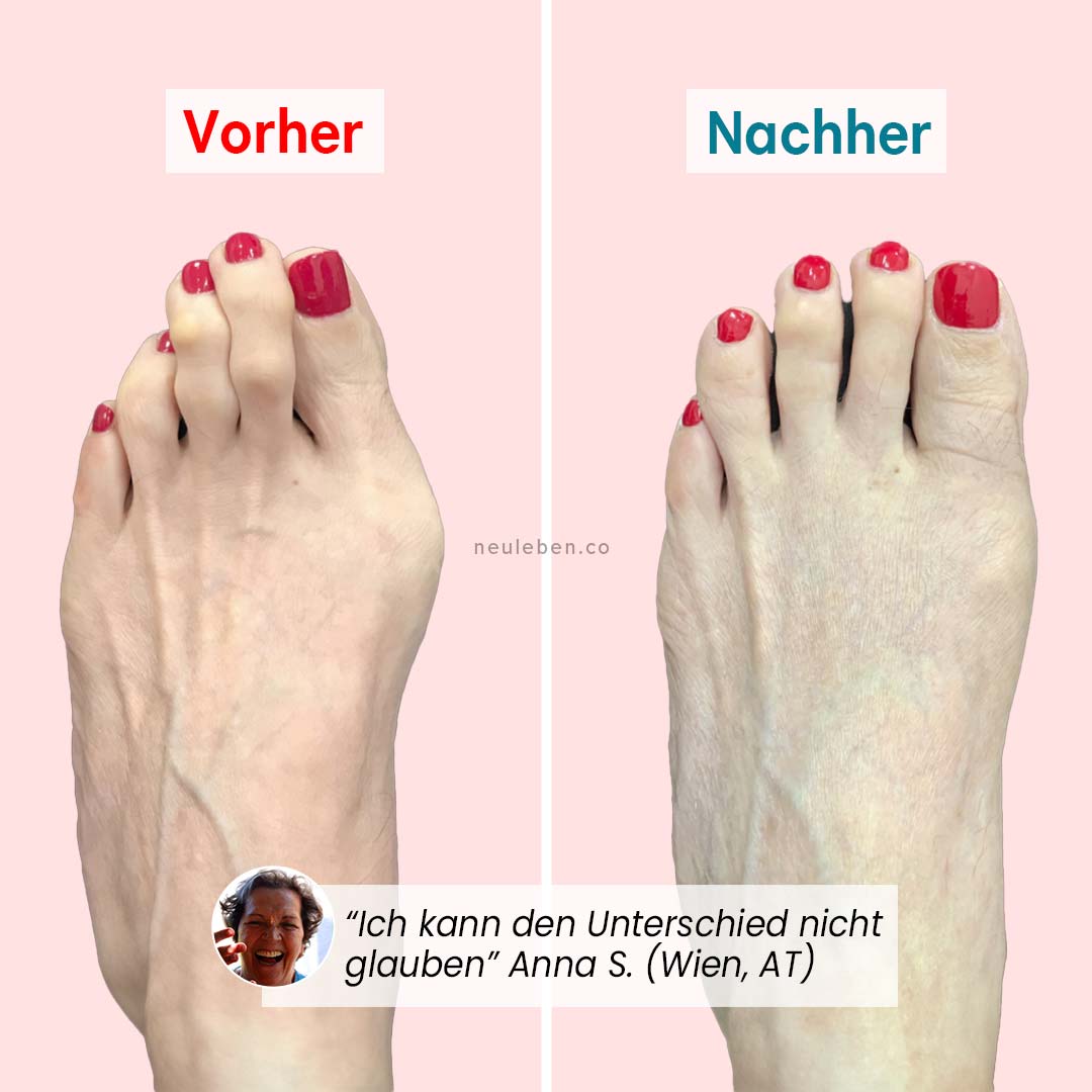 PerfectToes - Natürlicher Zehentrenner